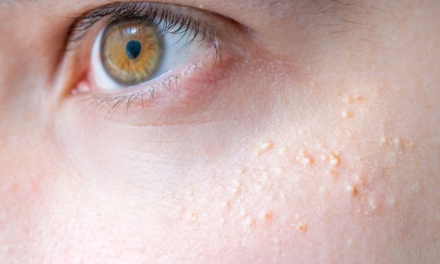 Milialar: How To Get Rid From this Skin Problem